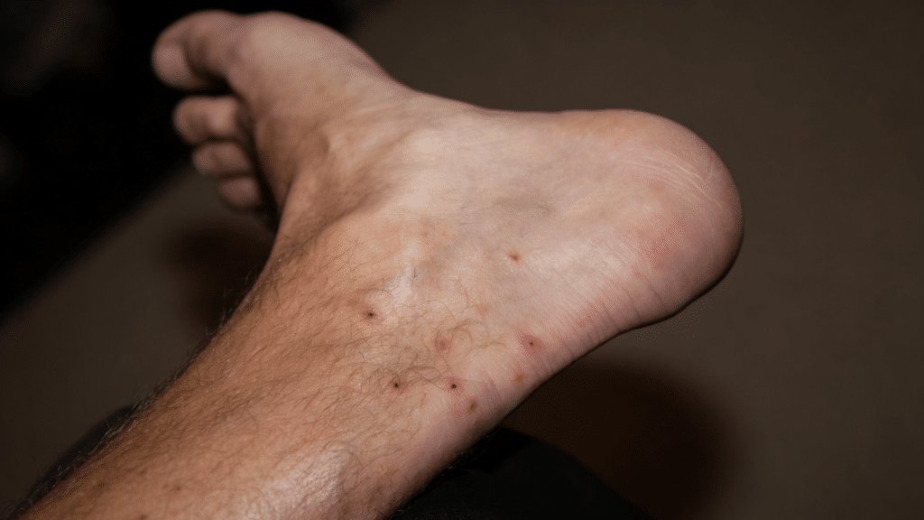 signs you have chiggers in your yard